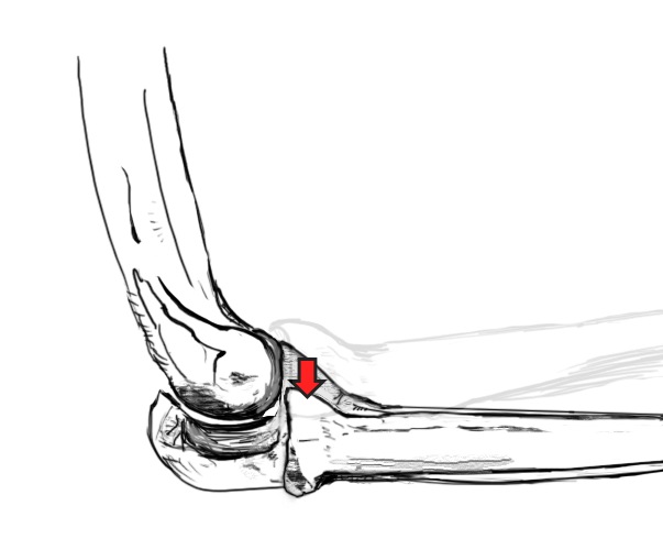 Posterolateral rotatory Instability